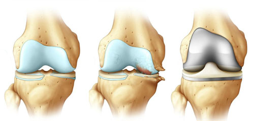 arthrose_evolution