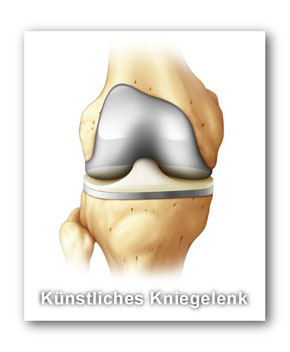 knie_tep